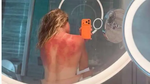 “El sol de Australia no es broma”: la imagen que volvió a encender la alerta sobre el cáncer de piel